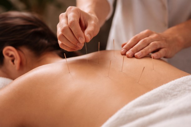 Acupuntura